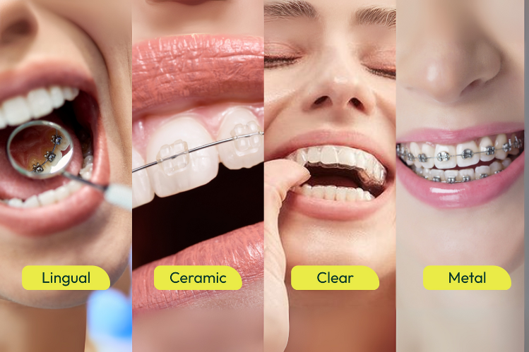 A side-by-side image of lingual braces, ceramic braces, clear aligners, and metal braces