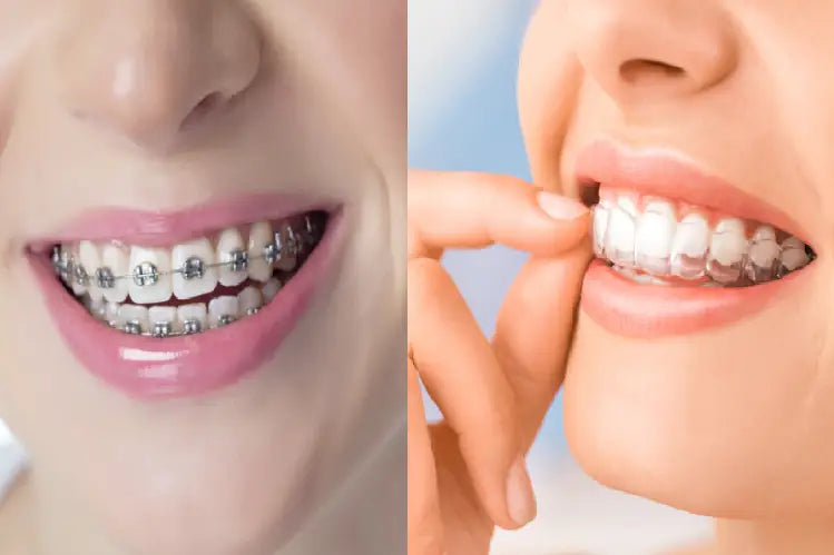 An illustration shows one girl wearing invisible aligners and the other one wearing braces