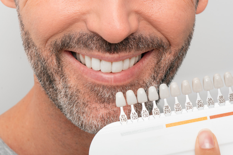 A close-up of a man holding a shade card for whitening