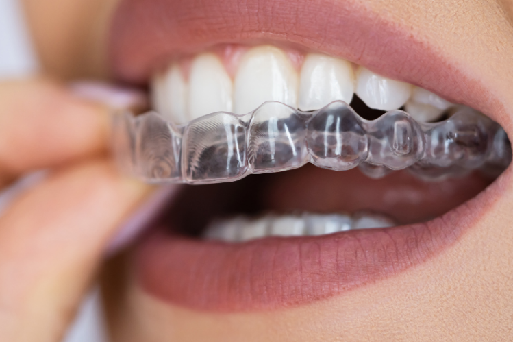 A close-up of a girl applying aligners before bed.