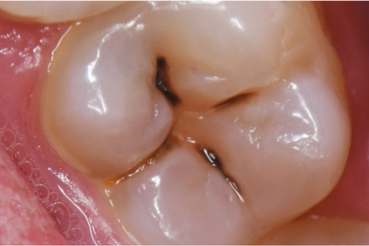 Image of a tooth with a cavity