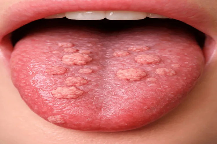 Image of a tongue with warts