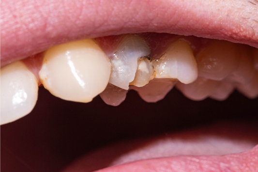 A close-up of a man suffering from a chipped tooth.