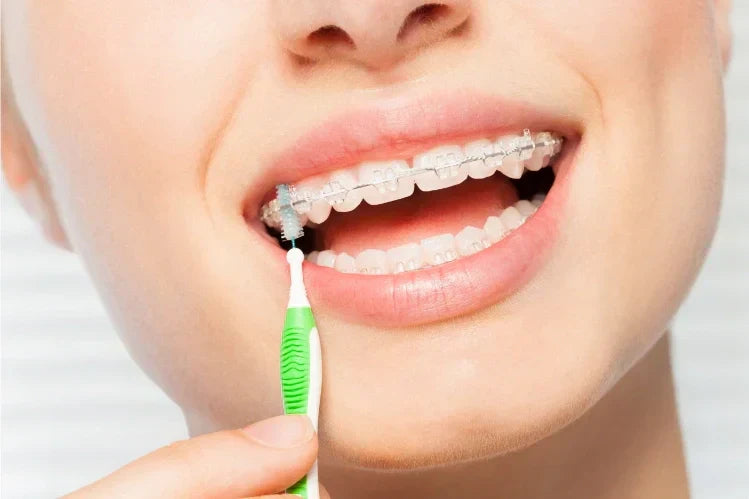 A girl uses a soft-bristled interdental brush for cleaning ceramic braces