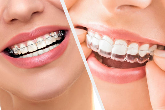 How Are Clear Aligners Better Than Ceramic Braces?