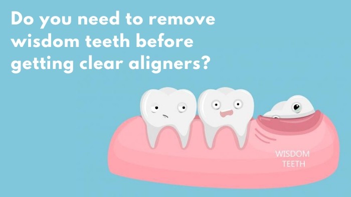 Can I wear my aligners with my wisdom teeth?