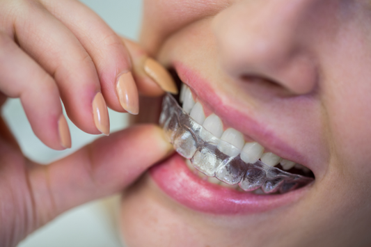 Close-up of a woman putting a clear aligner on her teeth