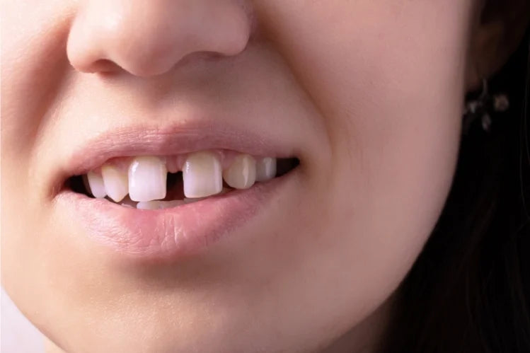 Close-up of gapped front teeth