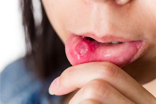 A person showing canker sores on their inner lip