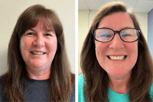  Dana Holbrook corrected her crooked tooth with ALIGNERCO