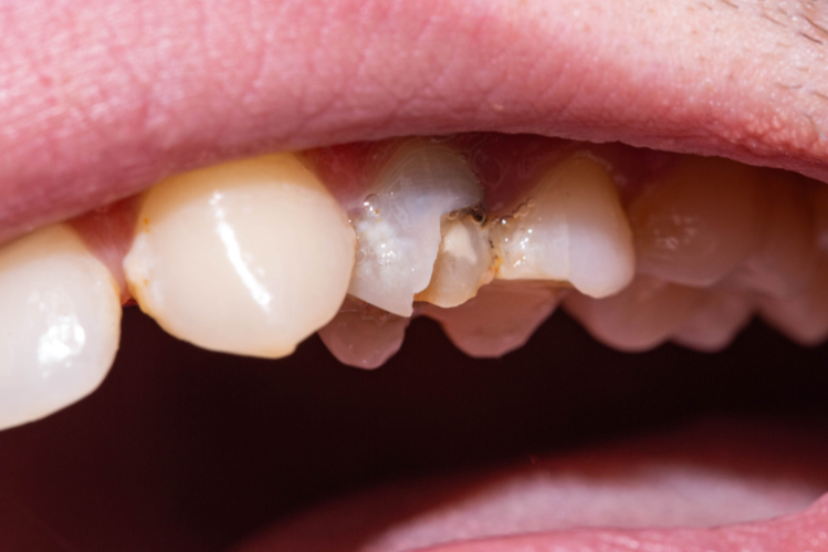 An image of a dead tooth with the enamel chipped off.