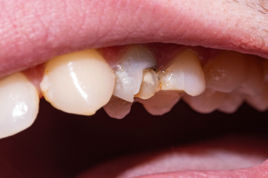 An image of a dead tooth with the enamel chipped off.