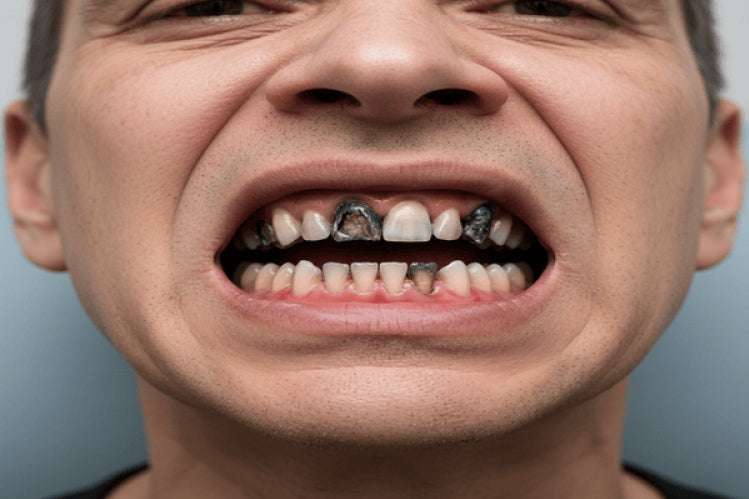 Fixing Meth Mouth: Dental Treatment Options to Restore Your Smile