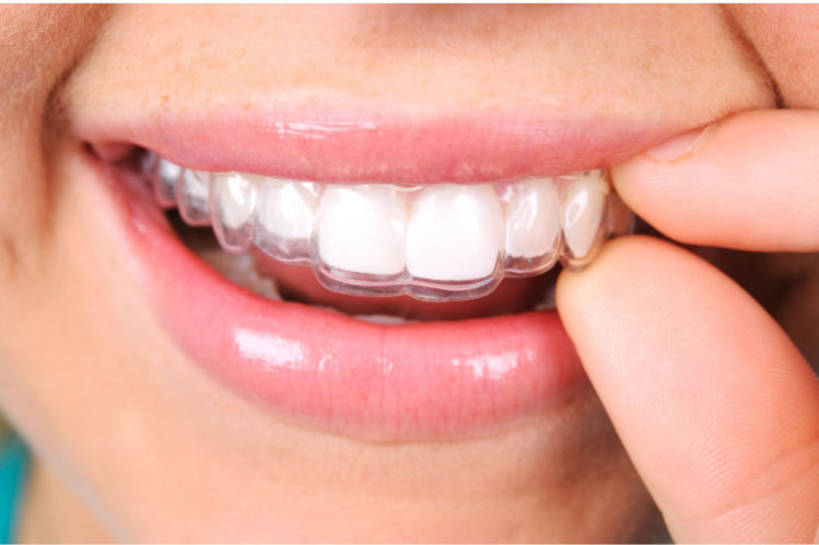a set of invisible dental retainers