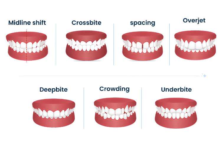 Different Bite Problems and Orthodontic