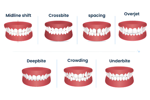 Different Bite Problems and Orthodontic Solutions With Clear Aligners