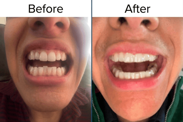 La transformación de la sonrisa en 6 meses de Alexander Kiessling con ALIGNERCO