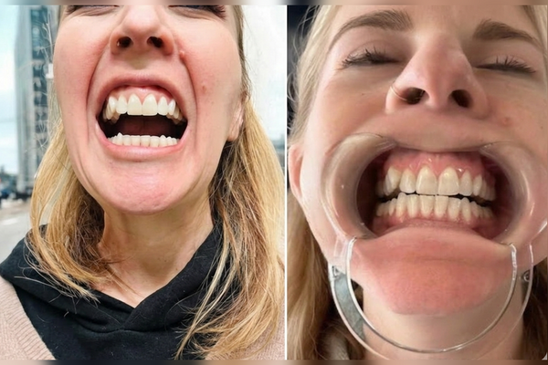 Teresa Murtha realinea los dientes protuberantes con ALIGNERCO
