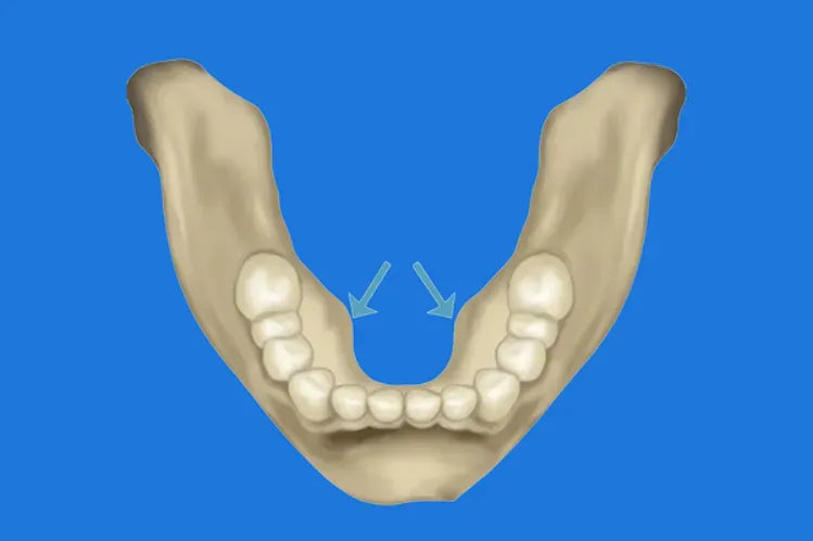 Torus Mandibularis: Understanding Bony Bumps in the Mouth