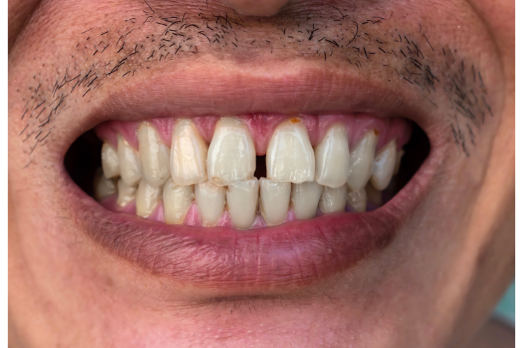 Close-up of a smile with a gap between the front teeth