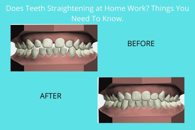 Does Teeth Straightening at Home Work? Things You Need To Know.