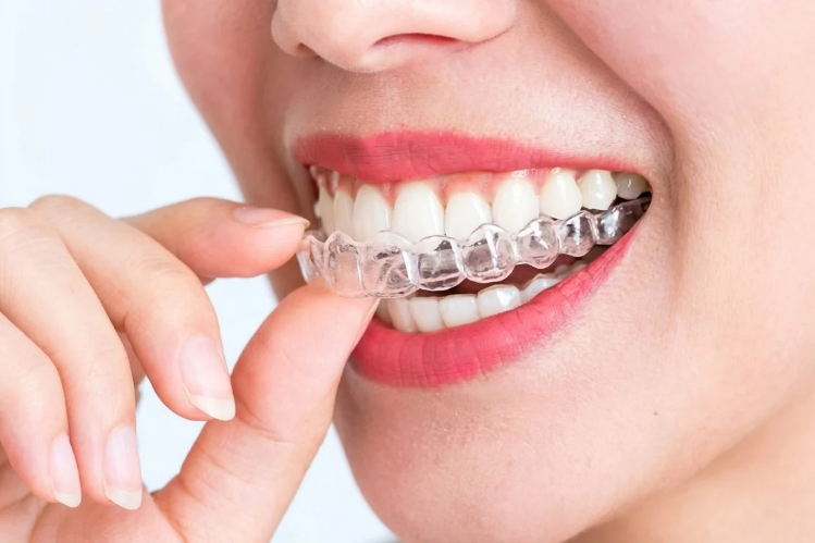 Smiling woman placing a clear aligner on her teeth