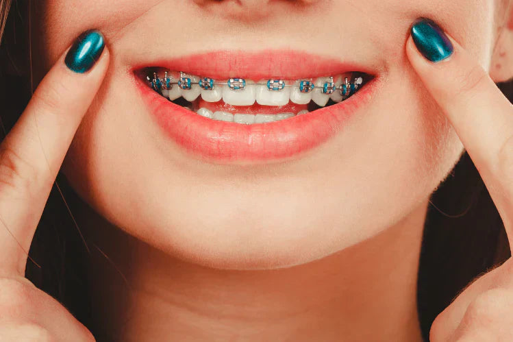 How Long Does It Take To Talk Normally With Braces
