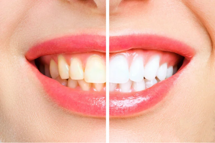 Before and after teeth whitening comparison of a smile