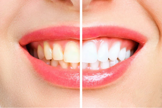 Before and after teeth whitening comparison of a smile