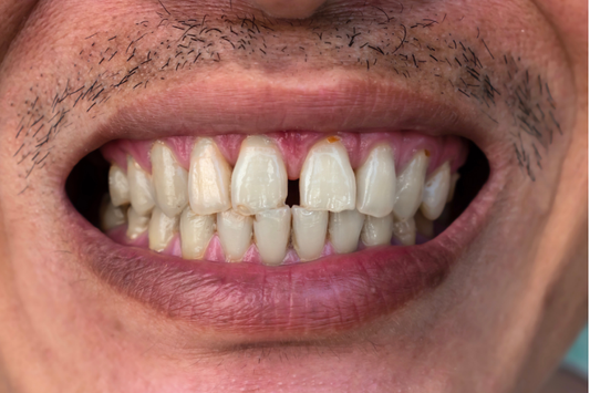 A close-up of a man with visible teeth gaps in the upper arch.