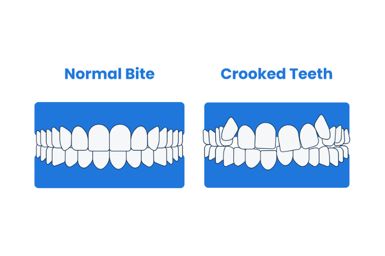 An illustration showing a normal bite and a misaligned bite side by side.