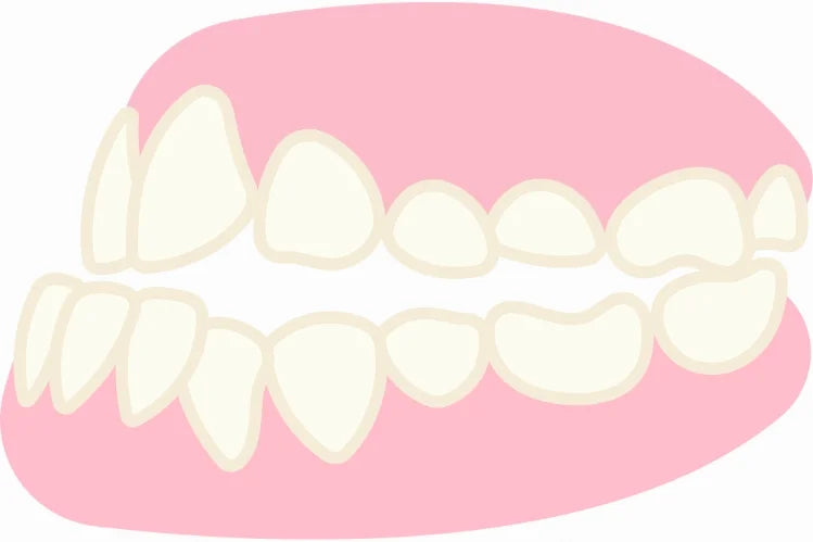 Illustration of how an underbite looks like