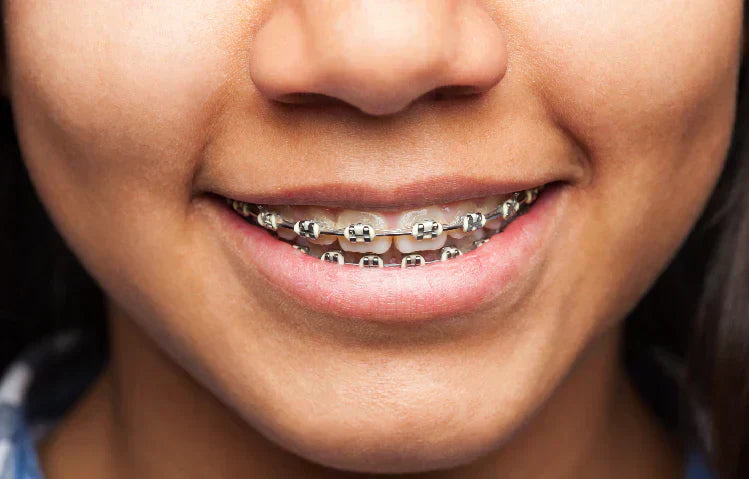 person smiling with braces