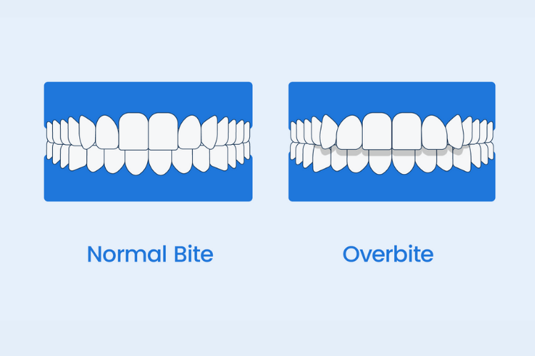 An illustration showing a normal bite and an overbite side by side.