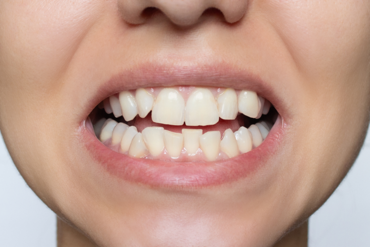 Close-up of a woman's smile showing crooked upper and lower teeth