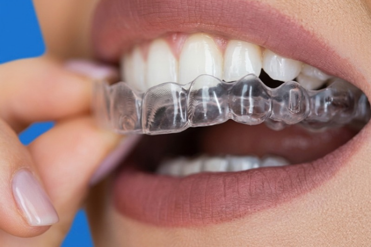 Close-up of a clear aligner being placed on teeth