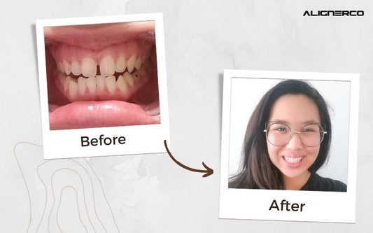 Sharon's Journey To A Picture Perfect Smile
