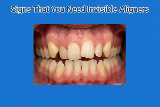Close-up of crooked and gapped teeth showing signs you need aligners