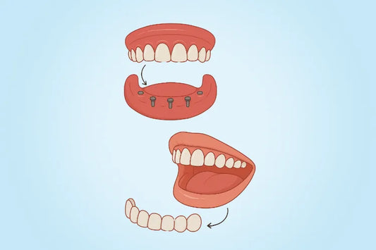 Illustration of snap-on veneers and snap-on dentures