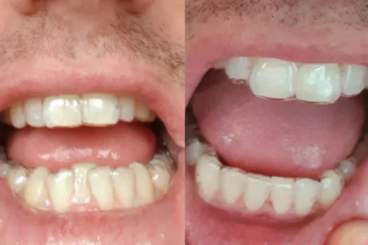  Teeth positioning before and after aligner treatment