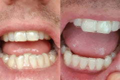 Clear Aligners Before and After: The Latest Wearer Intel