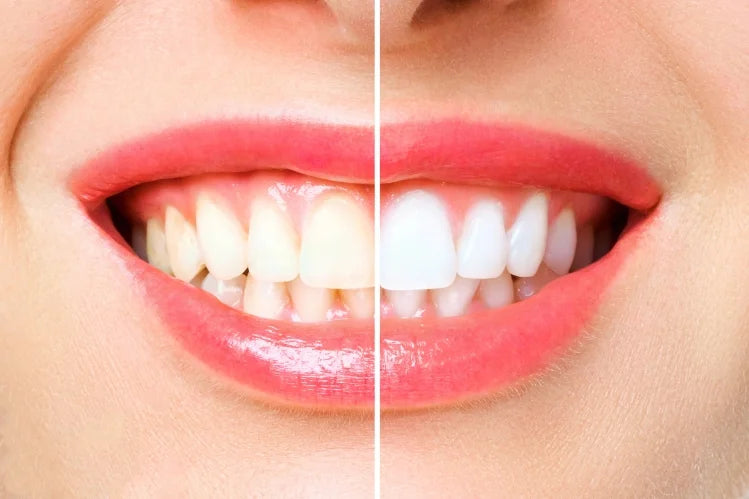 Teeth whitening before and after.