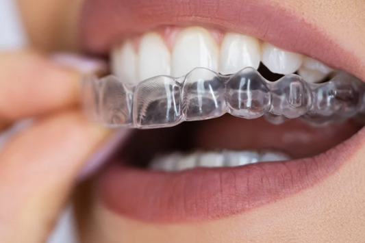 A close-up of a girl applying invisible clear aligners