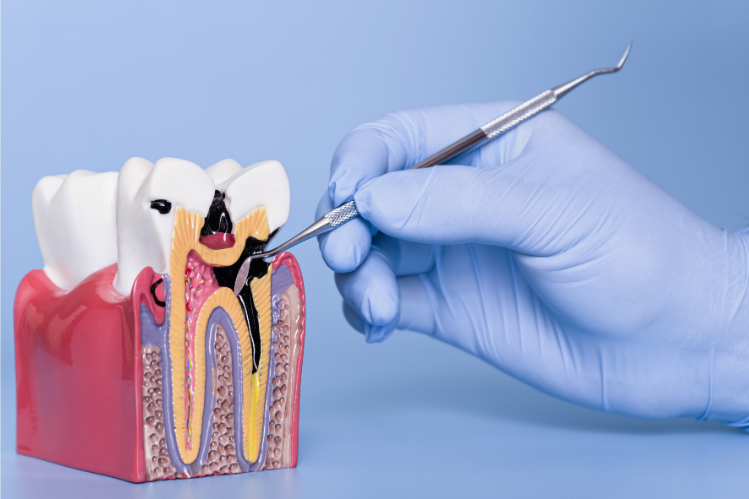 Dental model showing tooth decay with a dentist probe
