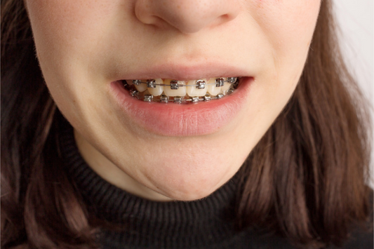 Close-up of a young woman smiling with metal braces on her teeth