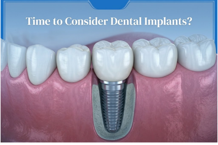 Illustration of a dental implant placed between natural teeth