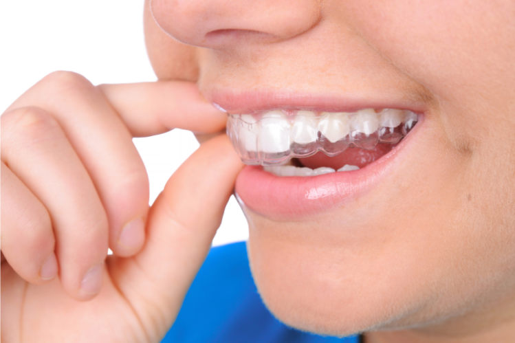 Smiling person placing a clear retainer on their upper teeth