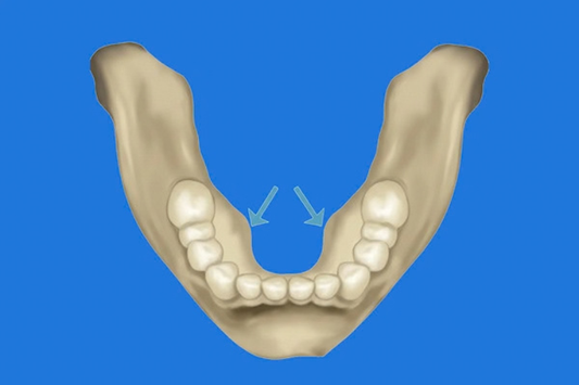 Mandibular Tori are bones under the tongue