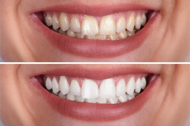 Before and after comparison of a smile with veneers