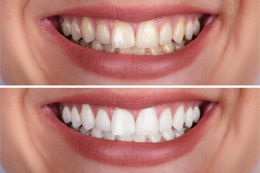 Before and after comparison of a smile with veneers